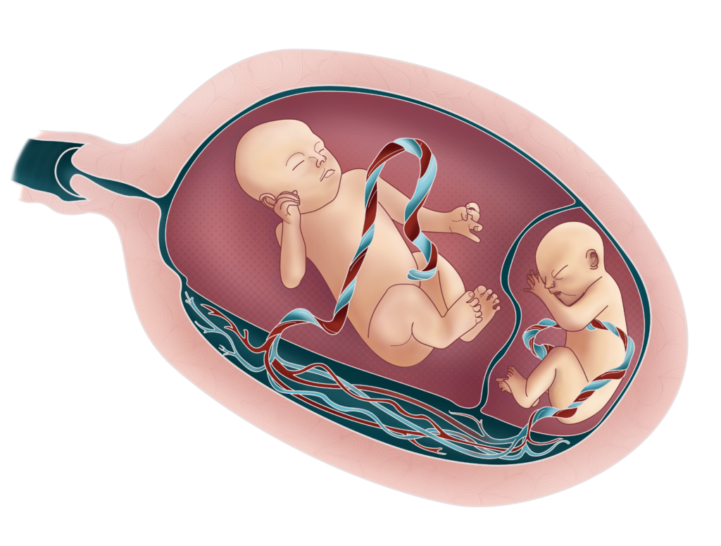 S Ndrome Da Transfus O Feto Fetal Gestar Medicina E Cirurgia Fetal